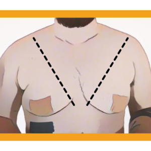 Trans tape is making my chest covered in pimples/red dots. Is there a what  to avoid it? : r/ftm